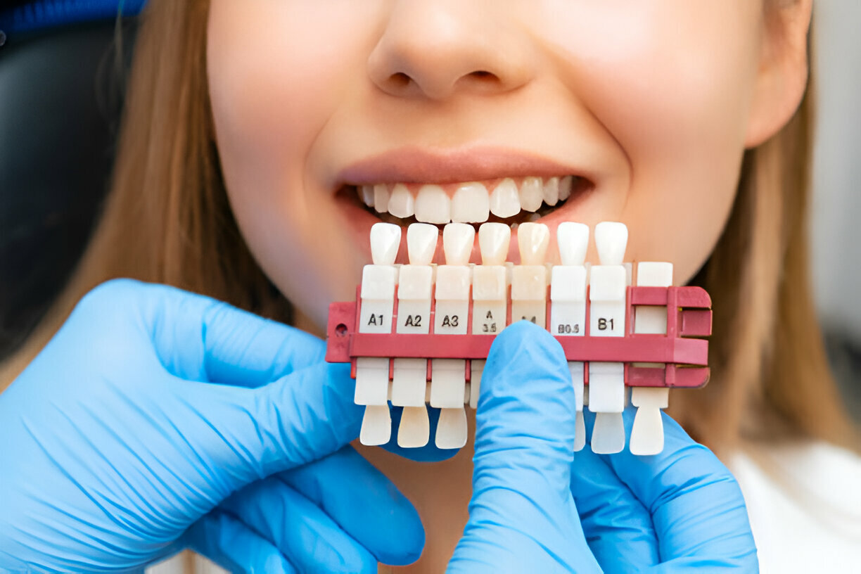 Porcelain Veneers: The Best Solution for a Perfect Smile in Prairie Village, KS – Cope Dentistry's Expertise_1