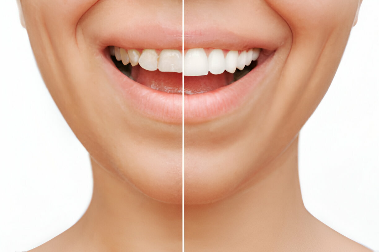 Porcelain Veneers: The Best Solution for a Perfect Smile in Prairie Village, KS – Cope Dentistry's Expertise_FI