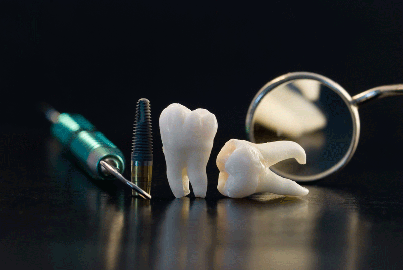 The Role of Dental Crowns in Restoring Oral Health in Prairie Village, KS_FI