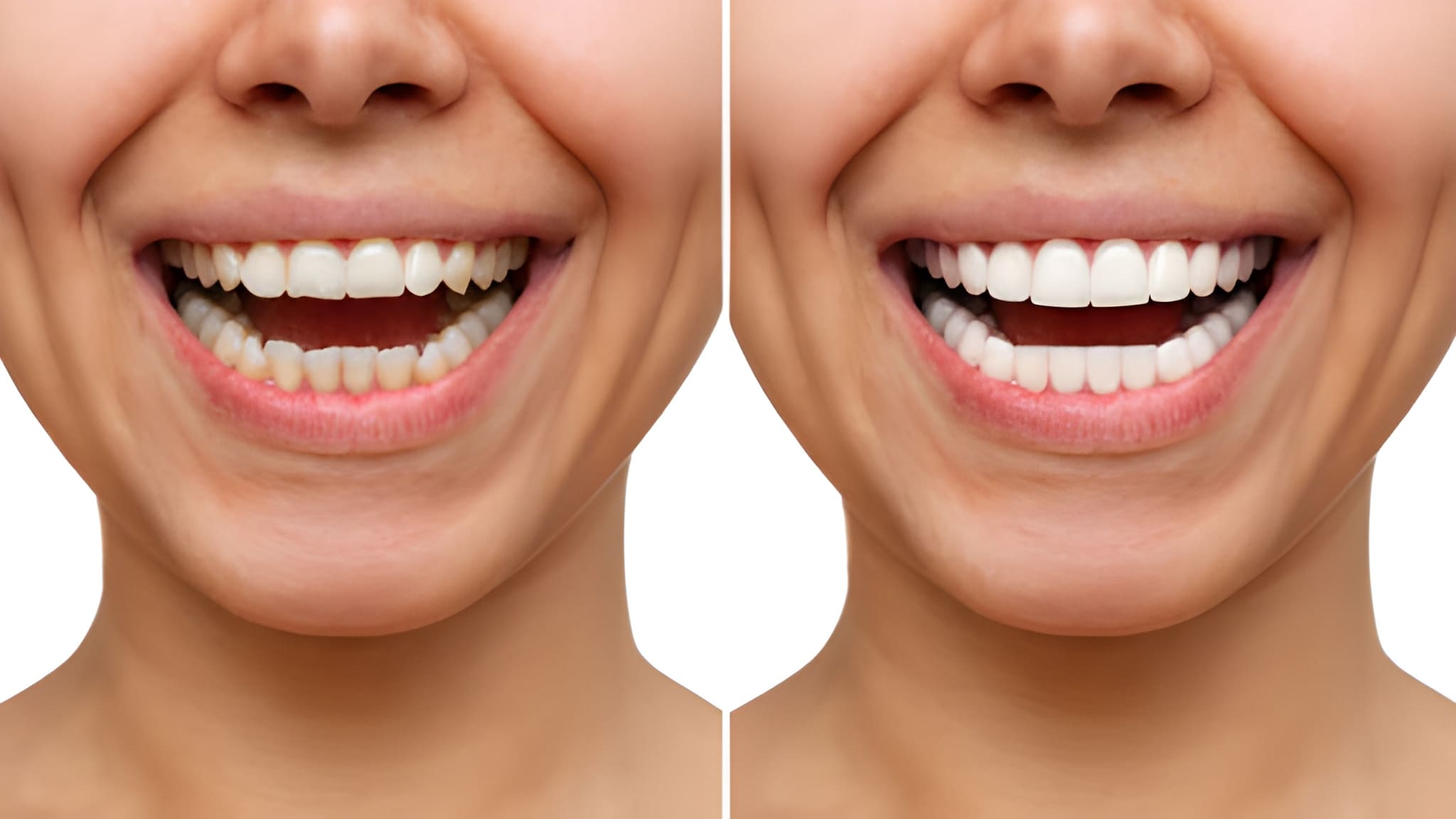 The Porcelain Veneer Process: What to Expect at Cope Dentistry_FI